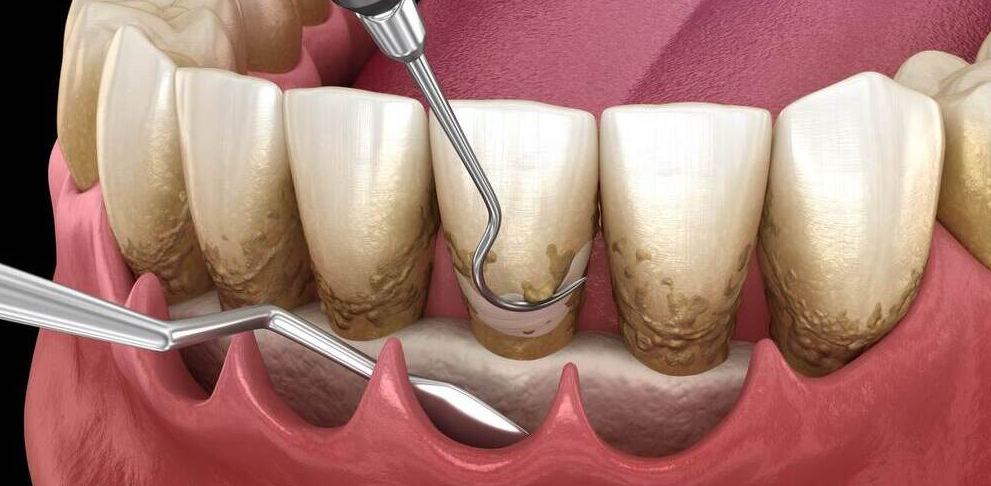 Serbest Diş Eti Grefti